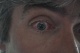 27-08-2011, Oog 11 dagen na de operatie