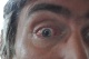 30-08-2011, Oog 2 weken na de operatie
