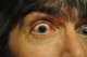 18-10-2011, Oog 9 weken na de operatie en 5 uur na de laser behandeling